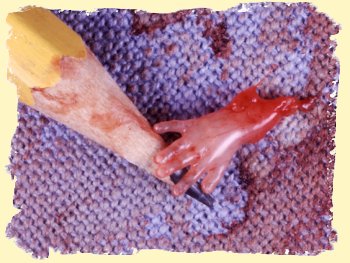 Severed Hand at 10 weeks from Center for Bio-Ethical Reform